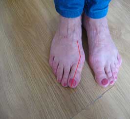 Hallux-Valgus-pied-droit