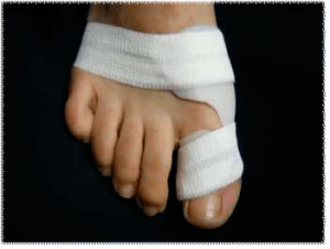 Hallux Valgus